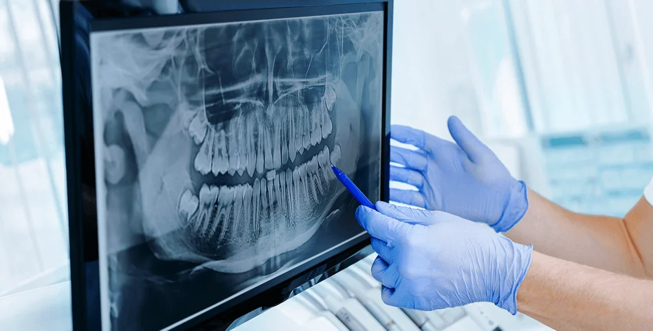 أشعات ديجيتال للأسنان